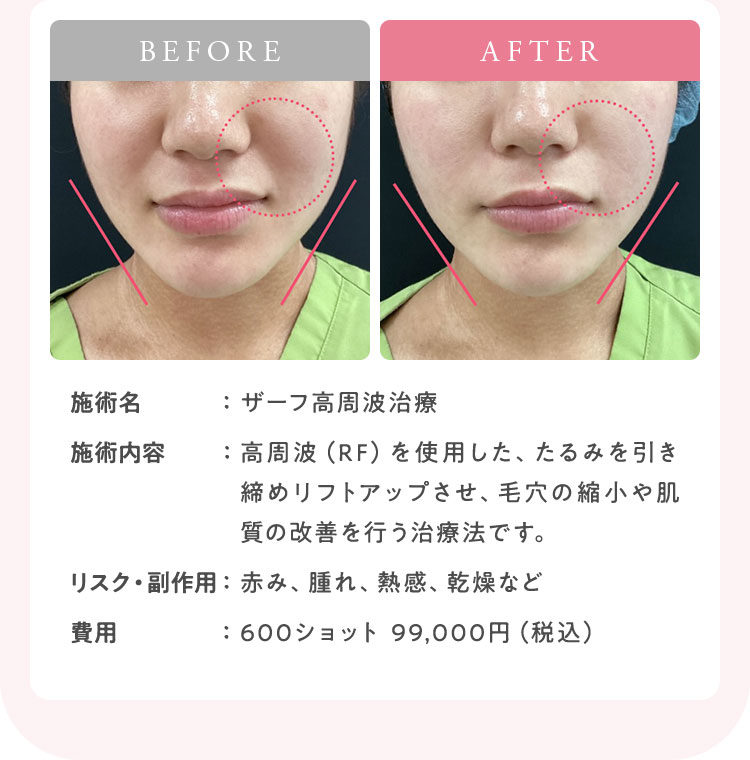 ザーフ高周波治療